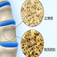 【骨密度分析儀科普】骨密度指標對照表，人手一份