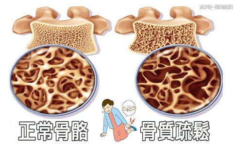 國產(chǎn)骨密度儀廠家介紹：骨密度不夠會產(chǎn)生哪些影響